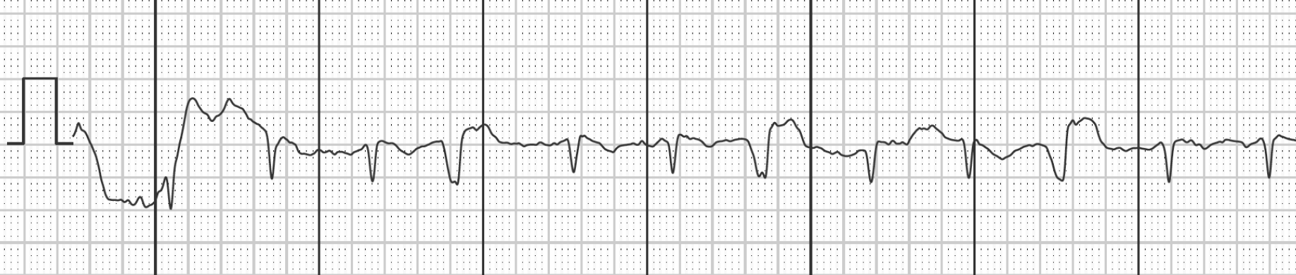 Graph showing unspecified lead of a 1-lead-ECG Graph showing unspecified lead of a 1-lead-ECG