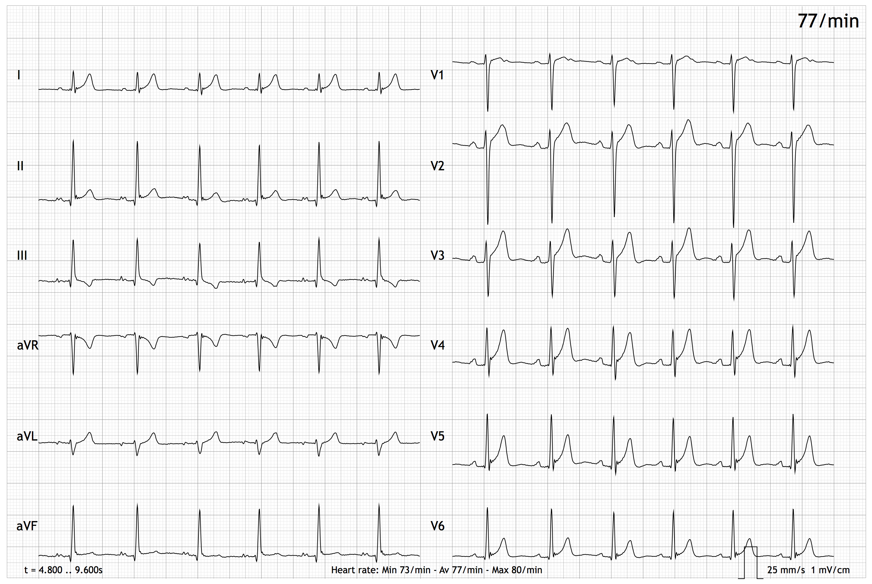 Graph showing the leads (I, II, III, aVR, aVL, aVF, V1-V6) of an EASI ECG Graph showing the leads (I, II, III, aVR, aVL, aVF, V1-V6) of an EASI ECG