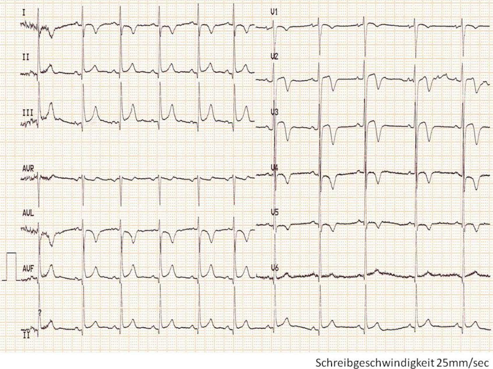 Graph showing the leads (I, II, III, aVR, aVL, aVF, V1-V6) of a 12-lead-ECG Graph showing the leads (I, II, III, aVR, aVL, aVF, V1-V6) of a 12-lead-ECG