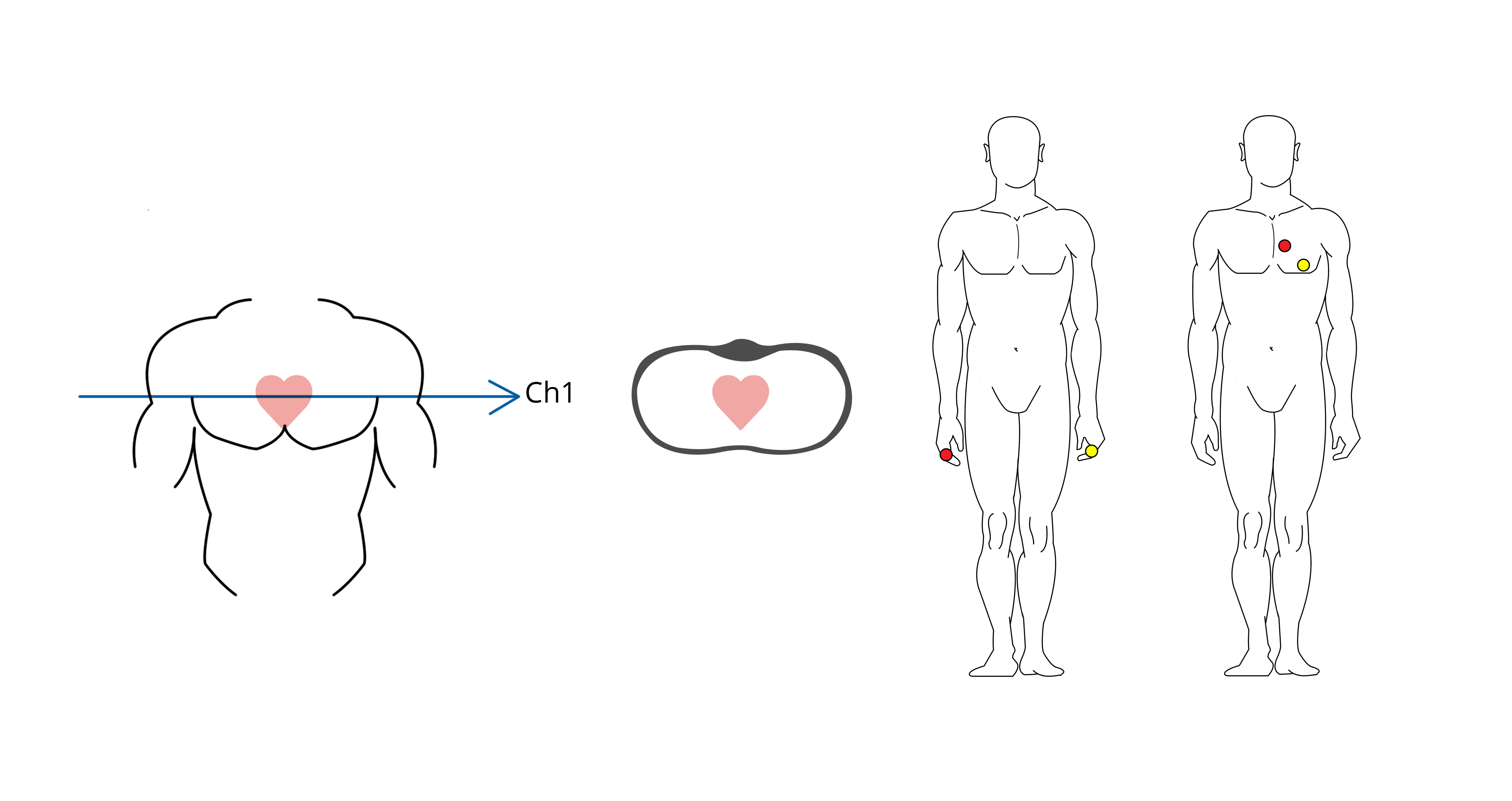 Spatial vector for lead I of a 1-lead-ECG and possible attachment points Image of spatial vector for lead I of a 1-lead-ECG and possible attachment points
