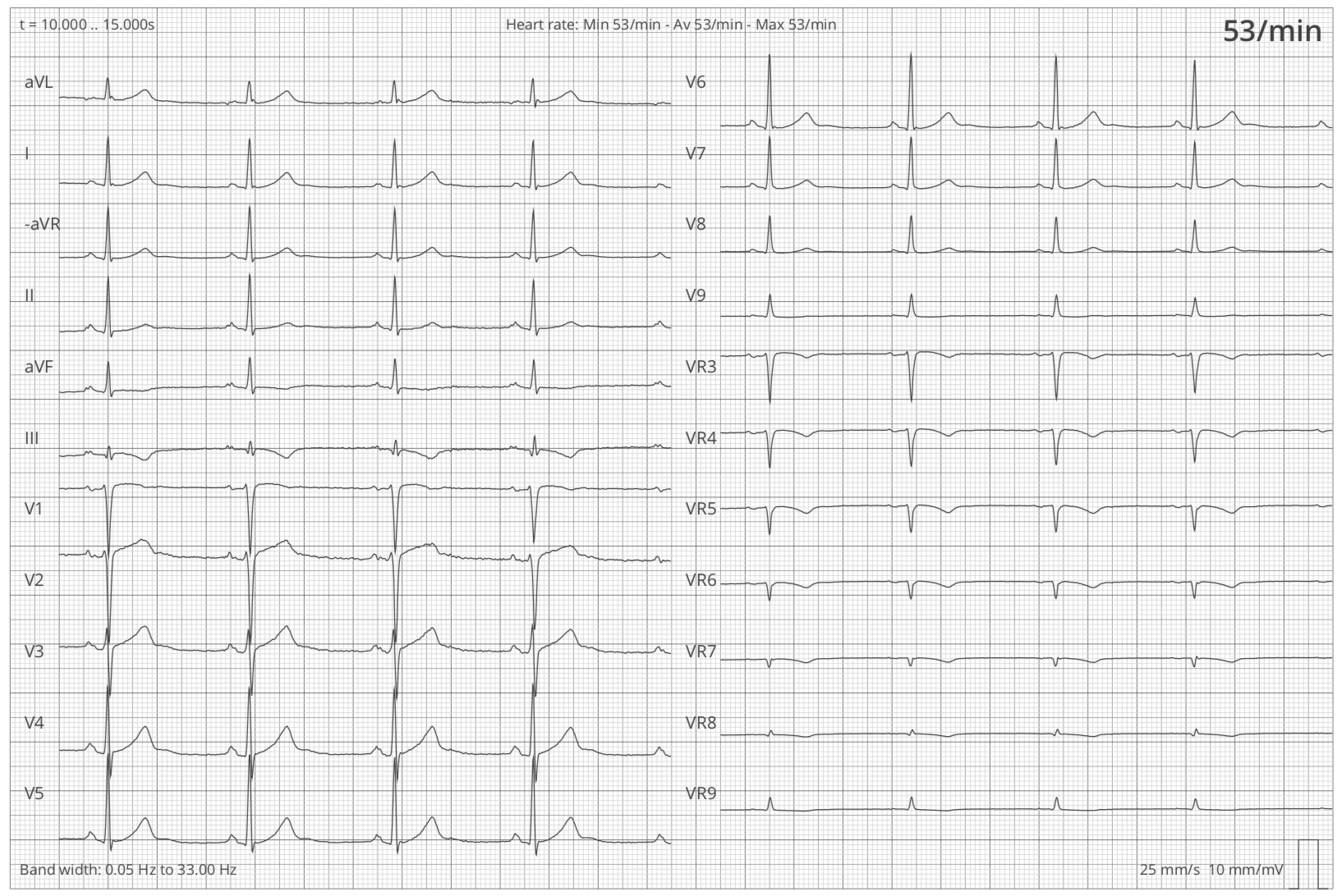 Graph showing the leads (I, II, III, aVR, aVL, aVF, V1-V9, VR2-VR9) of a 12-lead-ECG Graph showing the leads (I, II, III, aVR, aVL, aVF, V1-V9, VR2-VR9) of a 12-lead-ECG