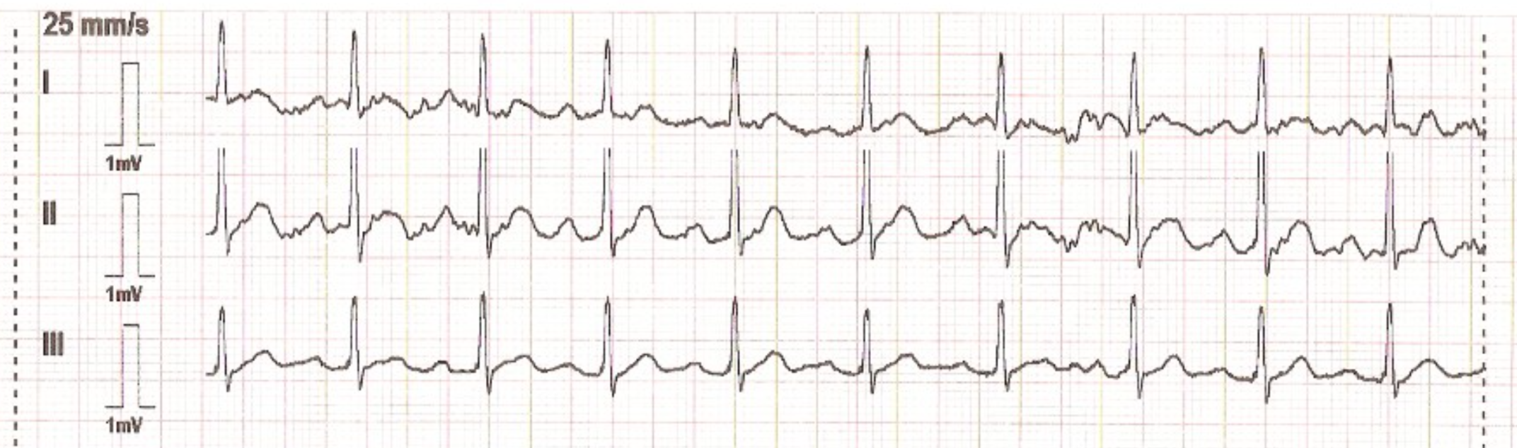Graph showing unspecified leads of a 3-lead-ECG Graph showing unspecified leads of a 3-lead-ECG