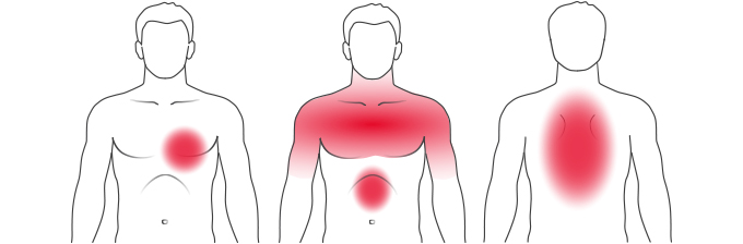 Typical symptoms of a heart attack Illustration of the most typical symptoms of a heart attack