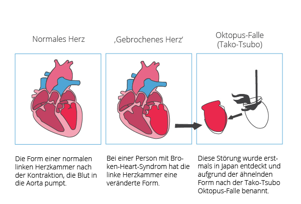 Normale linke Herzkammer vs. linke Herzkammer mit Broken-Heart-Syndrom Herz mit Broken-Heart-Syndrom