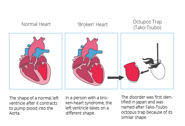 Normal left ventricle vs a left ventricle with broken heart syndrome Heart with broken heart syndrome