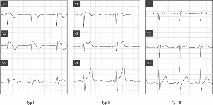 Mittels eines EKGs kann das Brugada-Syndrom erkannt werden Das Brugada-Syndrom: Verlässlich nur per EKG diagnostizierbar