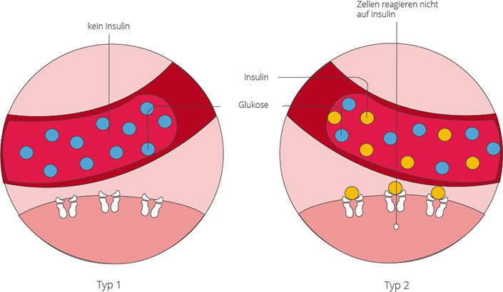 Diabetes mellitus lässt sich (mit Ausnahme von Sonderformen) in Typ 1 und Typ 2 unterscheiden Die Formen von Diabetes mellitus: Diabetes Typ 1 und Typ 2
