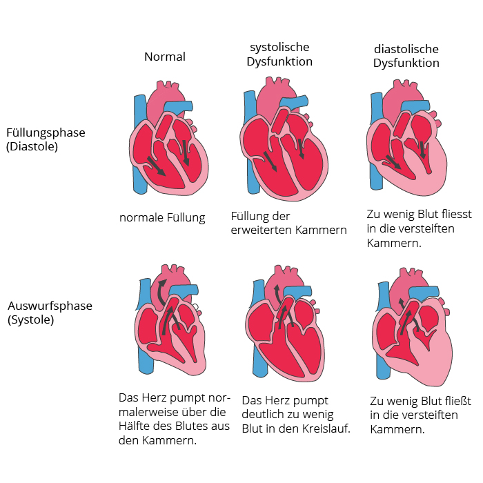 Gesundes Herz im Vergleich mit systolischer Dysfunktion und diastolischer Dysfunktion Grafische Darstellung eines gesunden Herzens im Vergleich mit systolischer Dysfunktion und diastolischer Dysfunktion