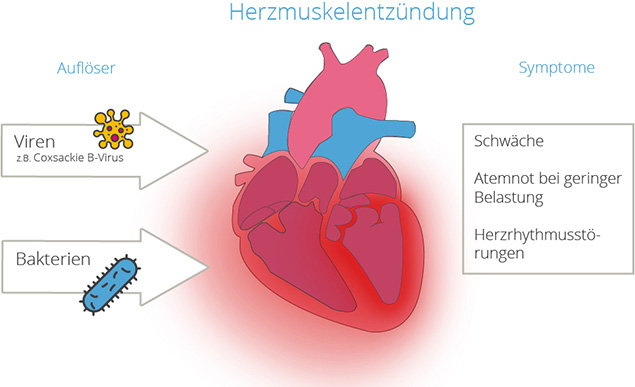 Bei einer infektiösen Herzmuskelentzündung sind Viren oder Bakterien die Krankheitursache Viren und Bakterien: Die Auslöser für eine infektiöse Herzmuskelentzündung