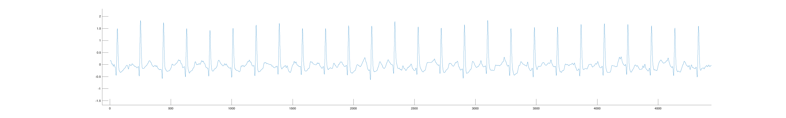 Steady sinus rhythm at 90 beats per minute Illustration of steady sinus rhythm at 90 beats per minute