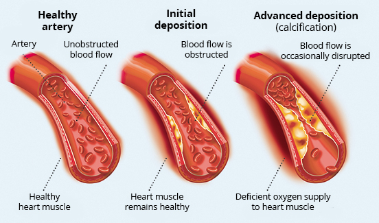 Comparison of a healthy artery with mild and severe arteriosclerosis Diagram of an artery in three stages of arteriosclerosis