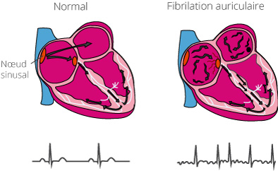 Fibrillation atriale : les impulsions électriques qui ne proviennent pas du nœud sinusal sont transmises de façon incontrôlable et les oreillettes fibrillent. En cas de fibrillation auriculaire, les impulsions électriques générent des contractions désordonnées